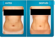 Beneficios del lipolaser